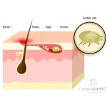 Skin Diseases: Human Scabies